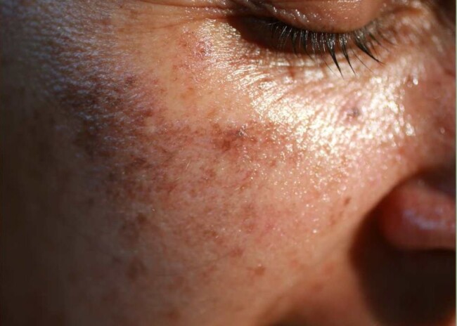 hyperpigmentation