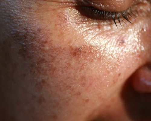 pigmentation